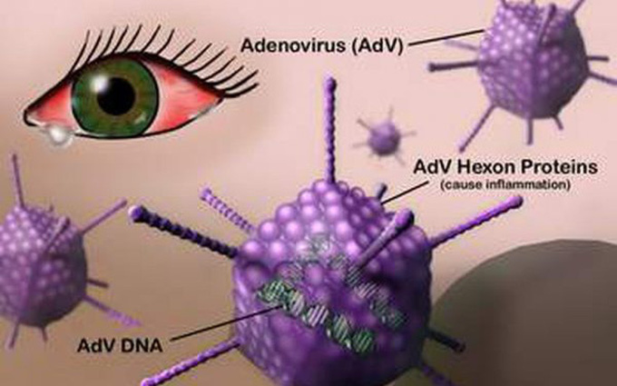 Bệnh đau mắt đỏ do virus Adenovirus – là loại virus phổ biến nhất trong việc lây nhiễm bệnh